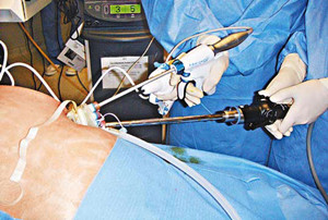 腹腔镜手术设备和器械