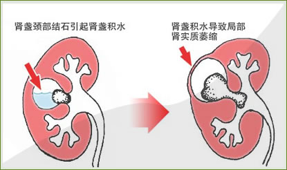 肾积水应该怎么办